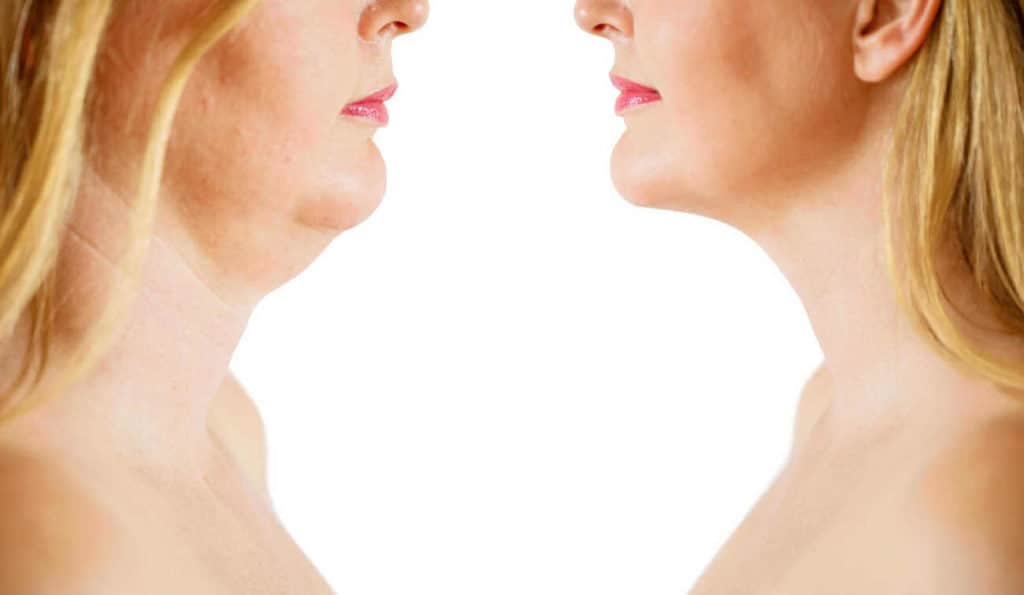 Double Chin treatment Busby before and after results