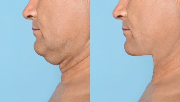 Which Non-Surgical Treatments Work Best for Jowls and Loose Skin Busby?