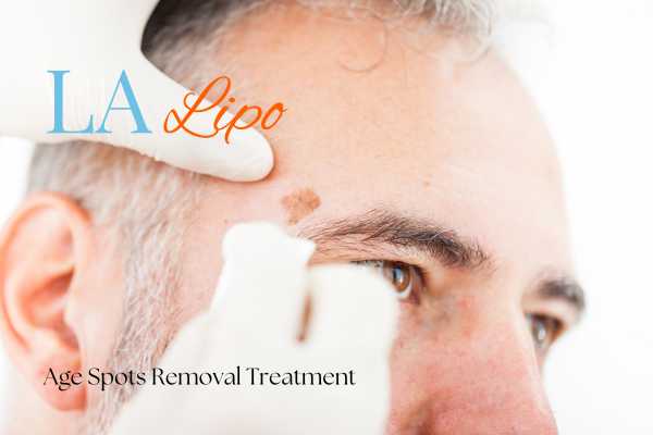 What Are the Most Effective Treatments for Age Spots Busby?