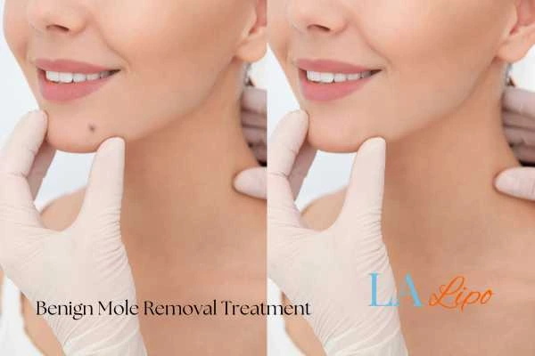woman's before and after mole removal Busby results