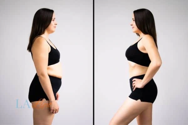 image of woman before and after results of LA-EMS Body Sculpting Busby to help treat Diastasis recti