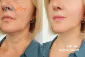 hi-fu for wrinkles Busby before and after results