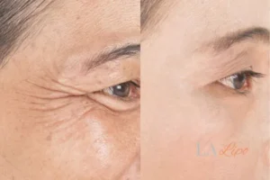Before and after results of woman - HI-fu wrinkles reduction treatment Busby