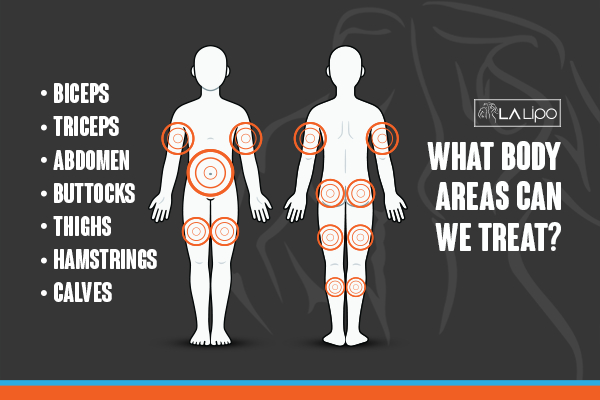 Graphic to show areas you can have LA-EMS Body Sculpting Busby treatment.
