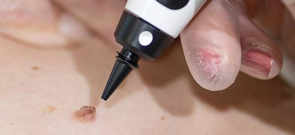 skin tag removal using cryopen Busby