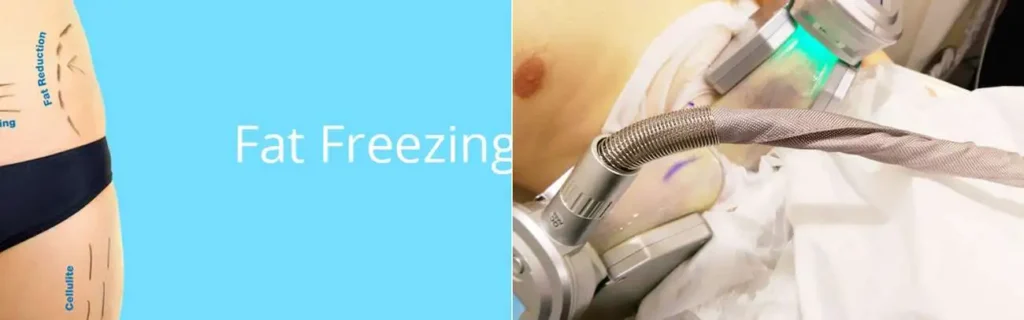 Fat freezing Busby on multiple areas of the body