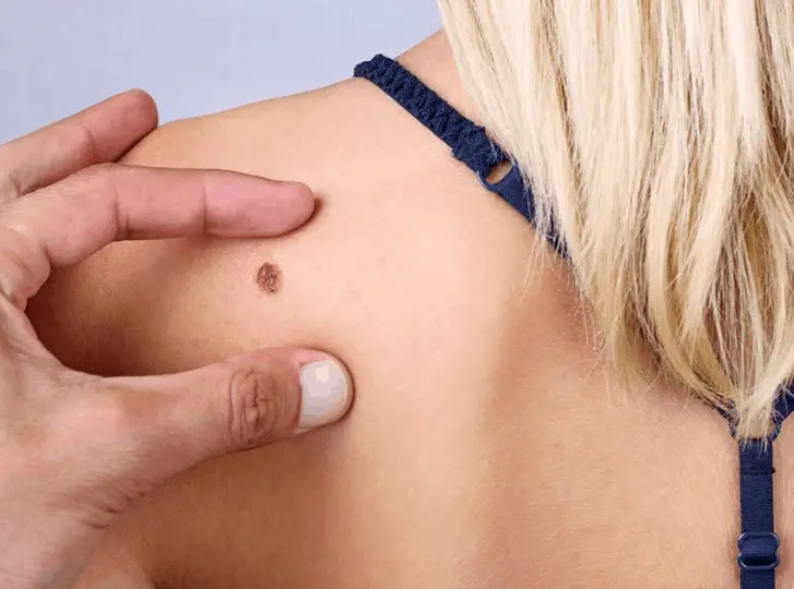 woman having mole removal Busby consultation before treatment.
