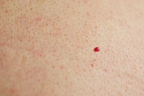 close up of a cherry angioma Busby