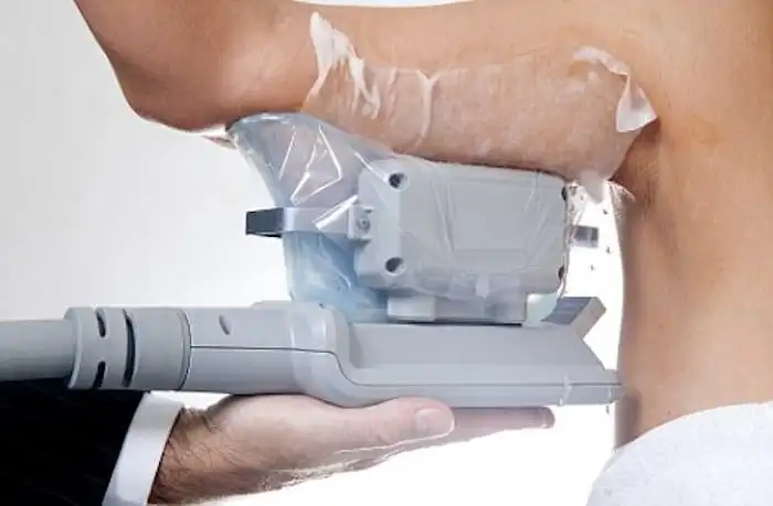 Picture of fat freezing Busby on the upper arms.