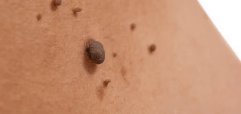 image of a skin tag Busby