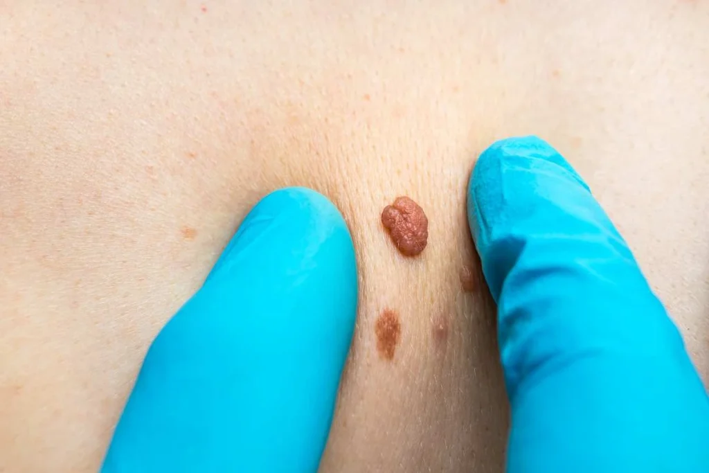 Consultant examining a skin tag Busby