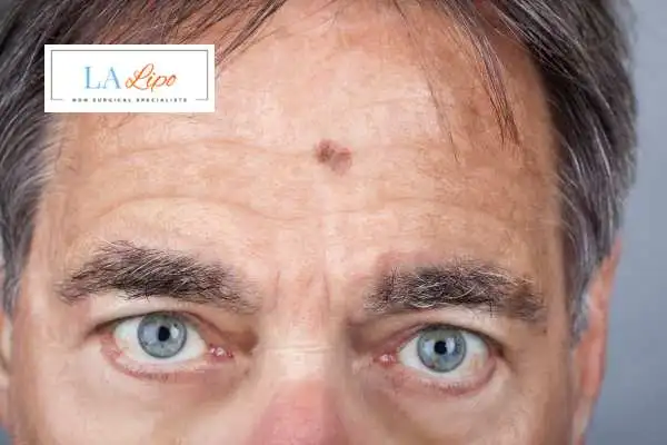 Solar Lentigo Removal Busby image of man with mark on his forehead
