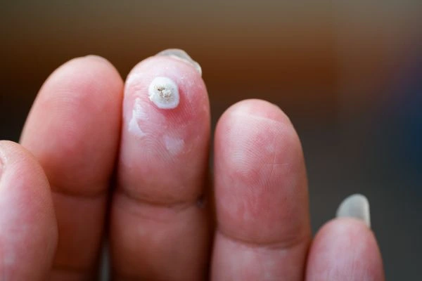 wart on person finger - cryotherapy to treat from LA LIPO Busby
