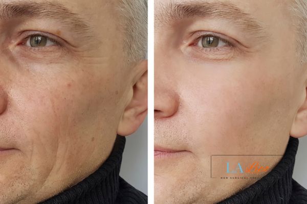See the amazing results of Morpheus8 Treatment Busby!