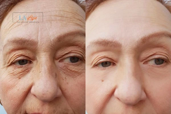 The powerful benefits of Morpheus8 Treatment Busby - Call Our team today!