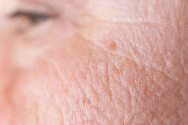close up picture of a woman's face showing an age spot Busby