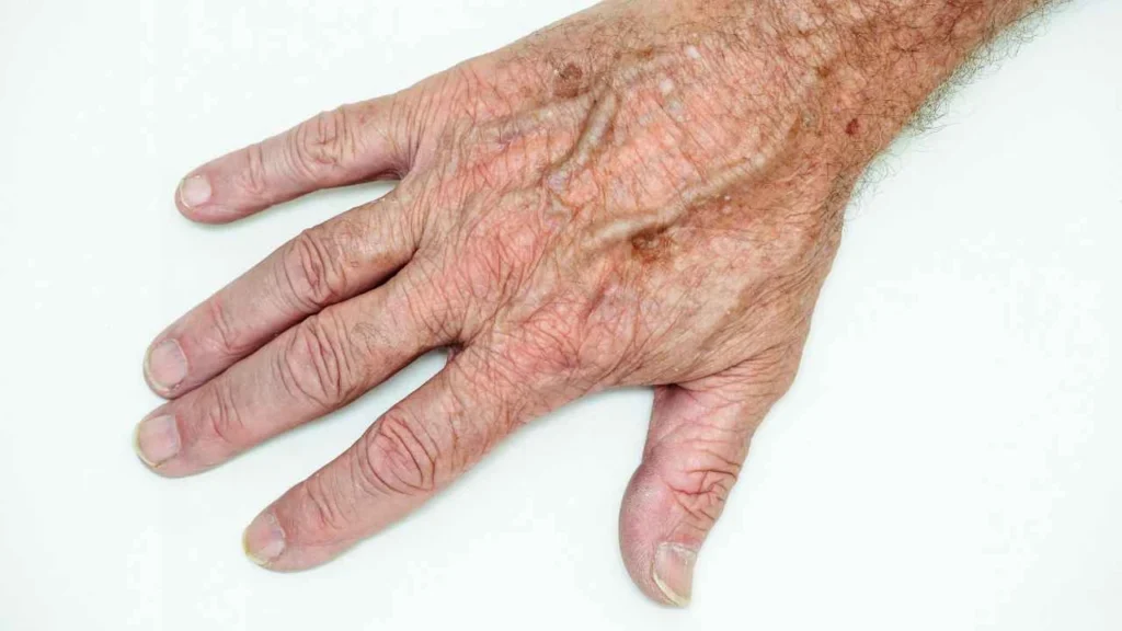 Male hand showing age spot Busby