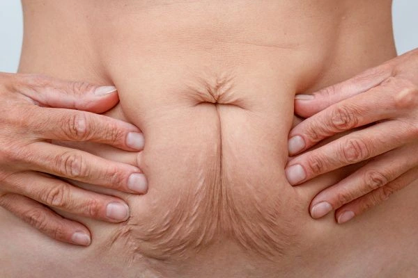 Should I Combine Diastasis Recti Treatment with Body Contouring for Better Results Busby?