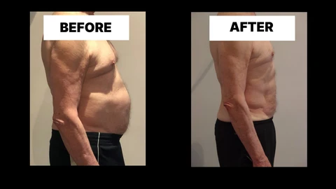 What Symptoms Can Diastasis Recti Cause in Men? Weak Core, Back Pain and Poor Posture Busby